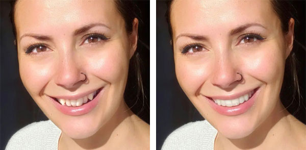 Invisalign in San Jose, CA