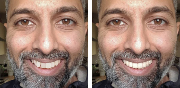 Invisalign in San Jose, CA